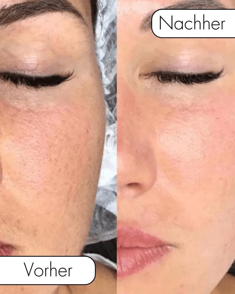 BB-Glow-Behandlung_Vorher_Nachher