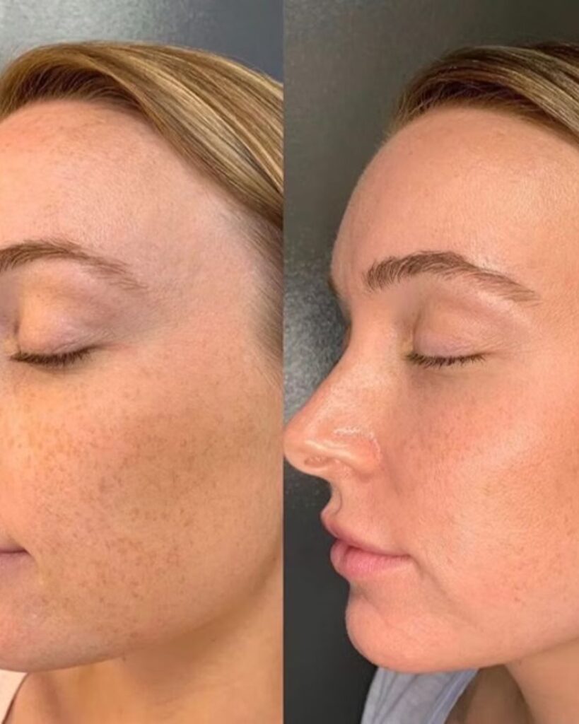 BB-Glow-Behandlung_Vorher_Nachher