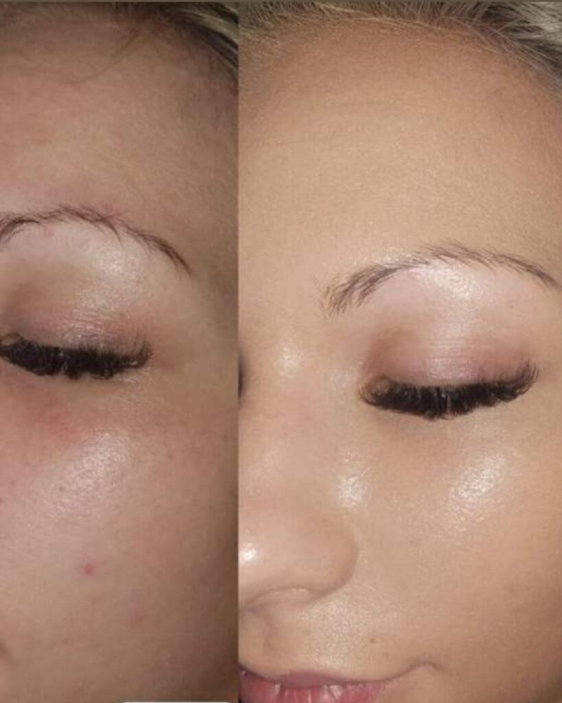 BB-Glow-Behandlung_Vorher_Nachher