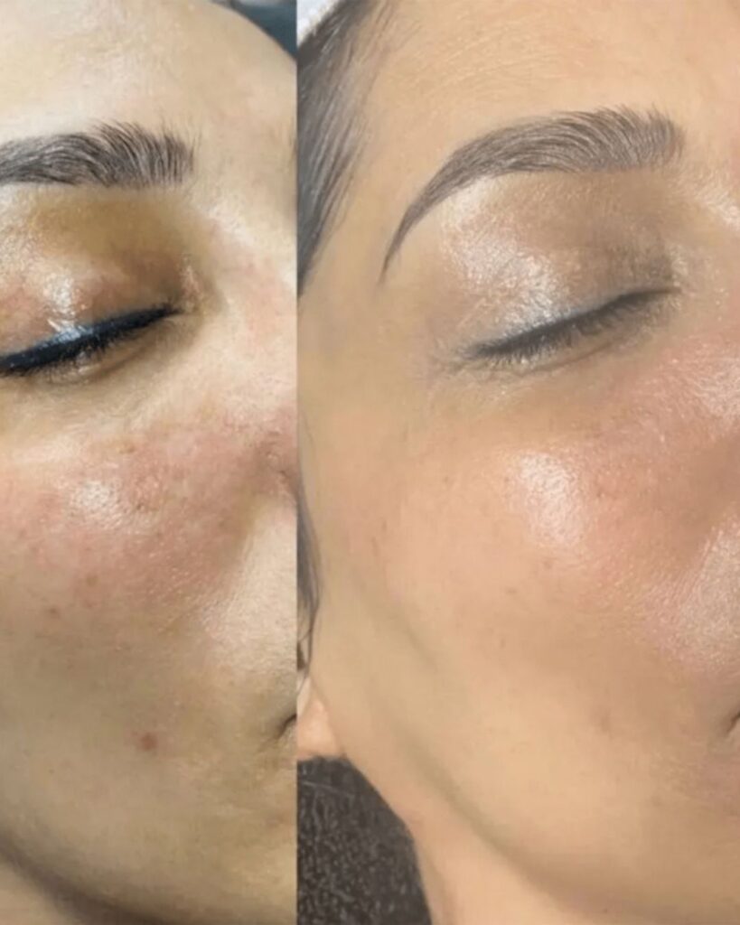 BB-Glow-Behandlung_Vorher_Nachher