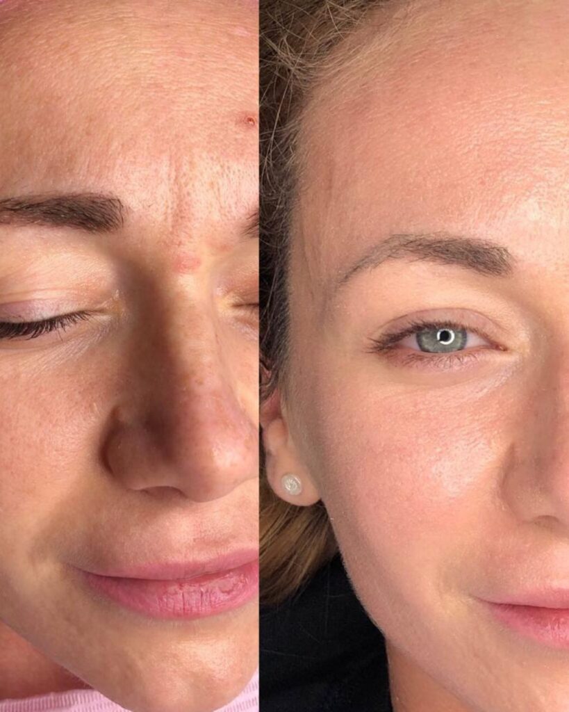 BB-Glow-Behandlung_Vorher_Nachher