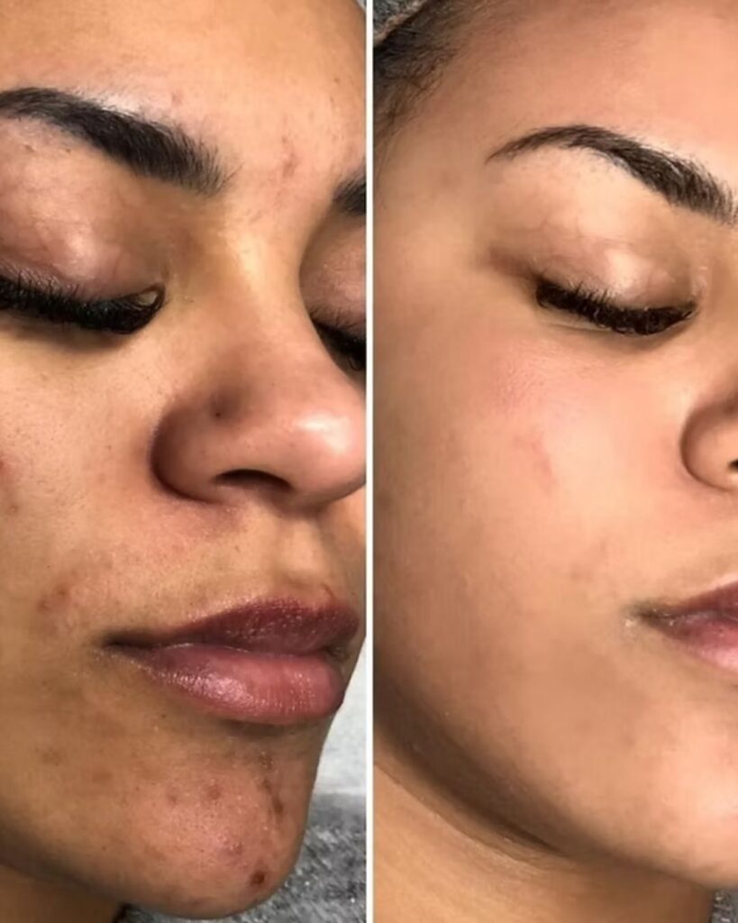 BB-Glow-Behandlung_Vorher_Nachher