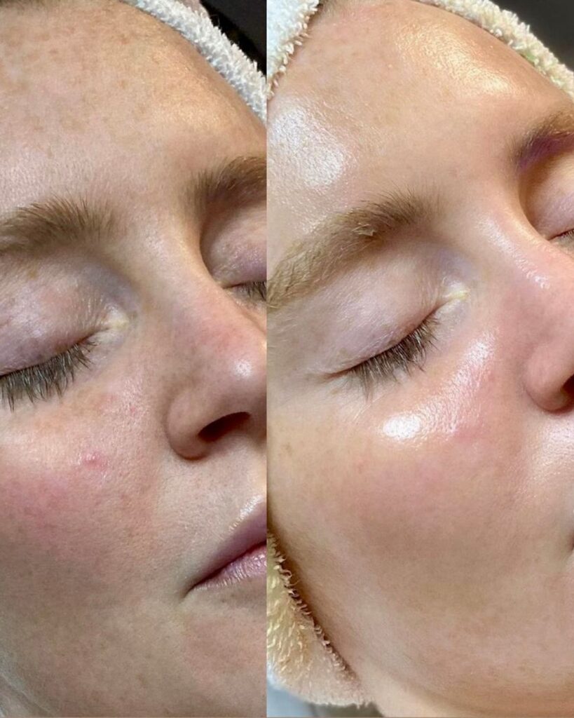 BB-Glow-Behandlung_Vorher_Nachher