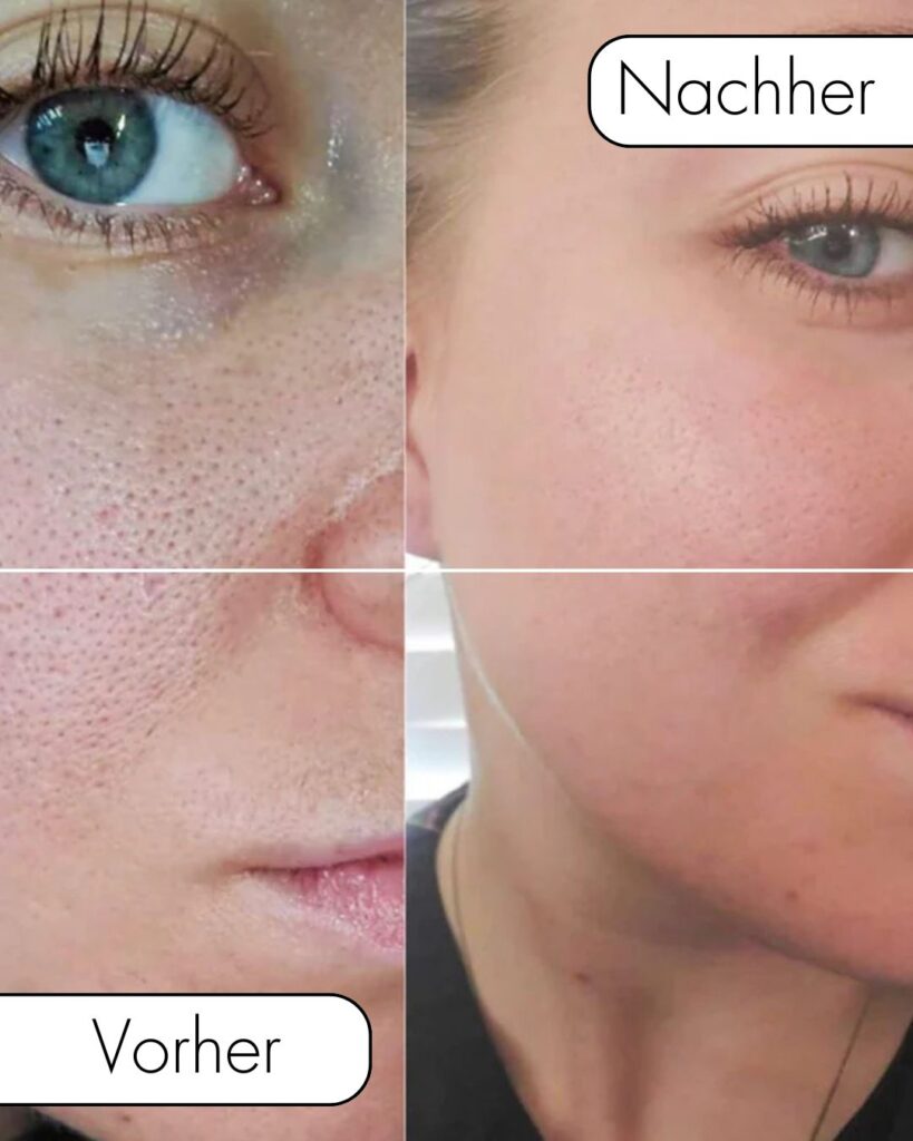 Gesichtsbehandlung Berlin Vorher Nachher