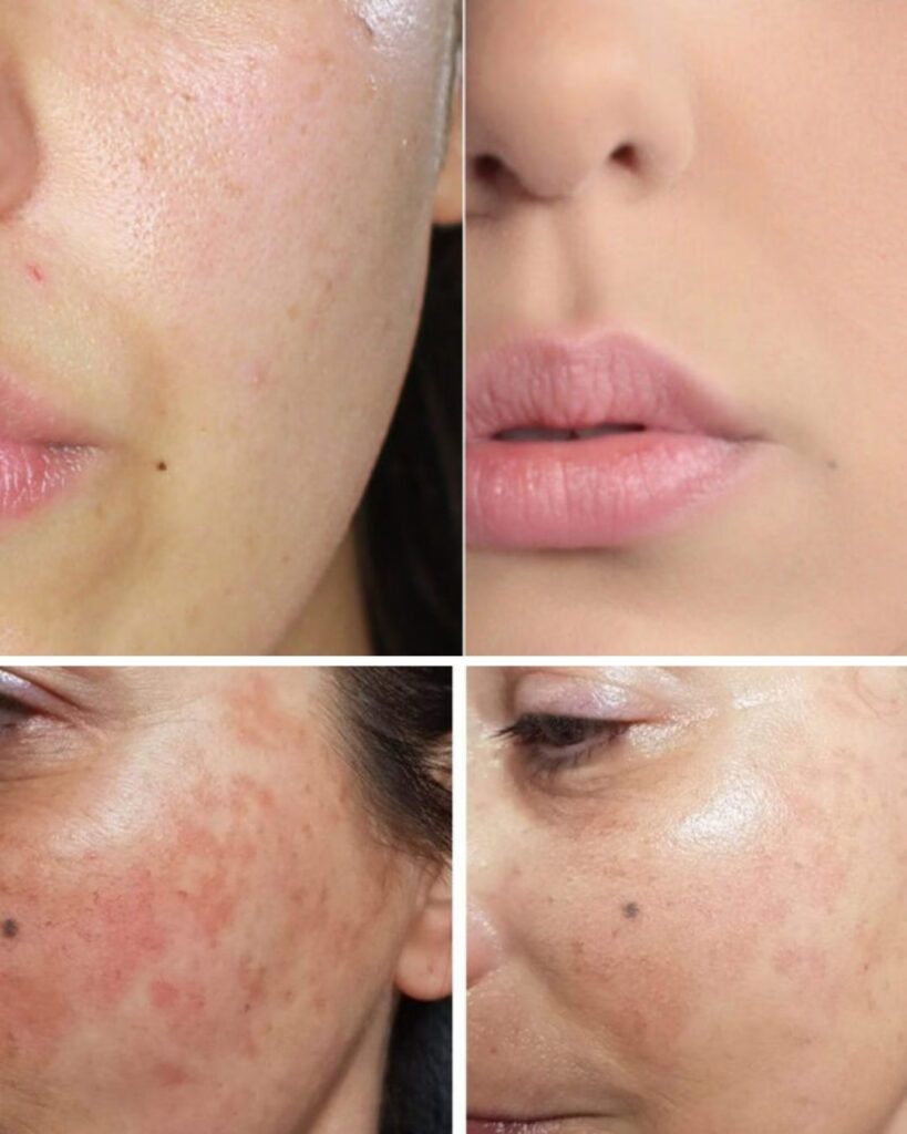 Gesichtsbehandlung Berlin Vorher Nachher