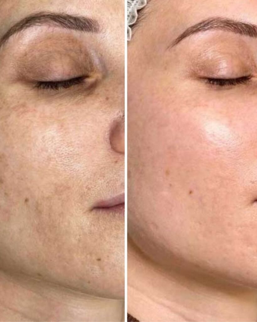 Gesichtsbehandlung Berlin Vorher Nachher