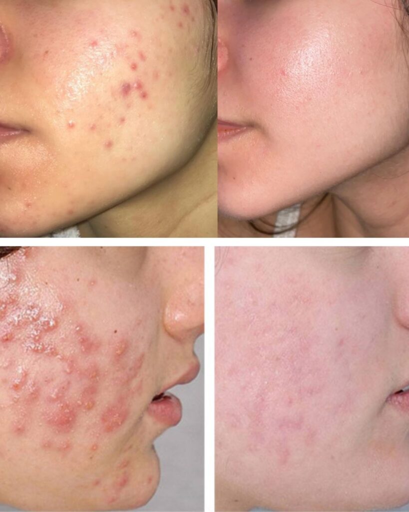 Gesichtsbehandlung Berlin Vorher Nachher