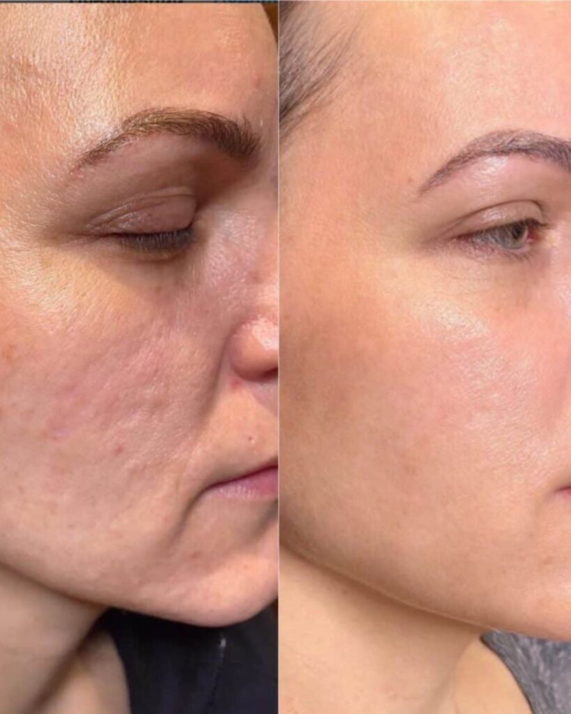 Gesichtsbehandlung Berlin Vorher Nachher