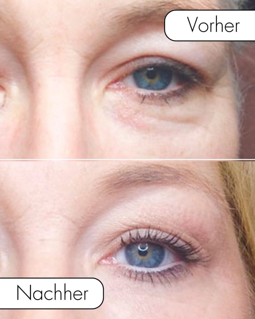 Plasma Pen Behandlung Berlin Vorher Nachher