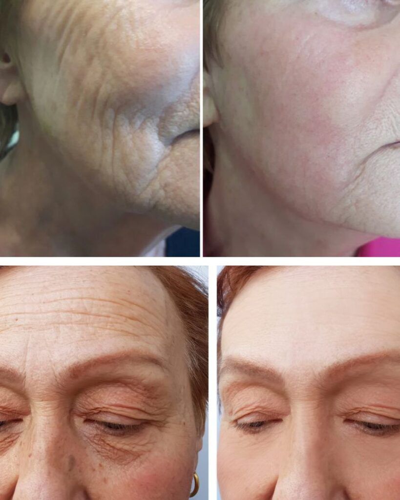 Plasma Pen Behandlung Berlin Vorher Nachher