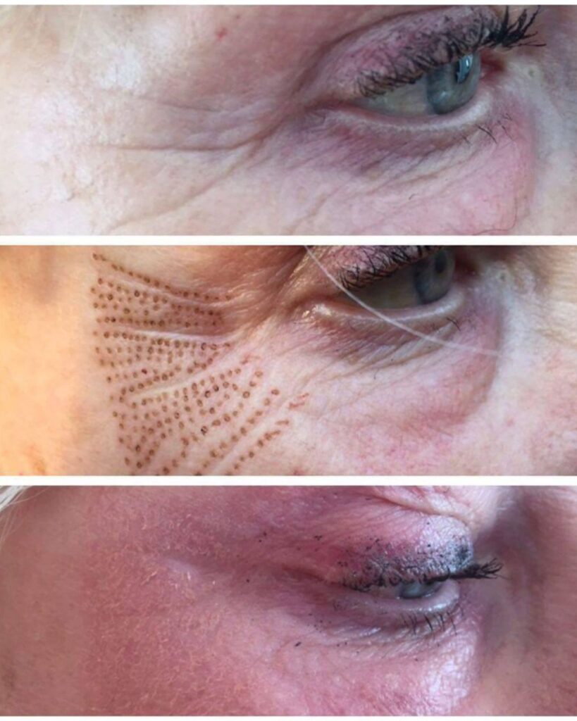 Plasma Pen Behandlung Berlin Vorher Nachher