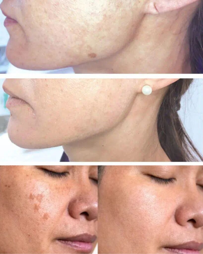 Plasma Pen Behandlung Berlin Vorher Nachher