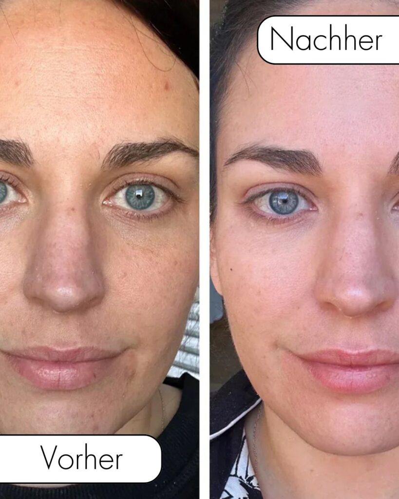 Microneedling-Behandlung_Vorher_Nachher_