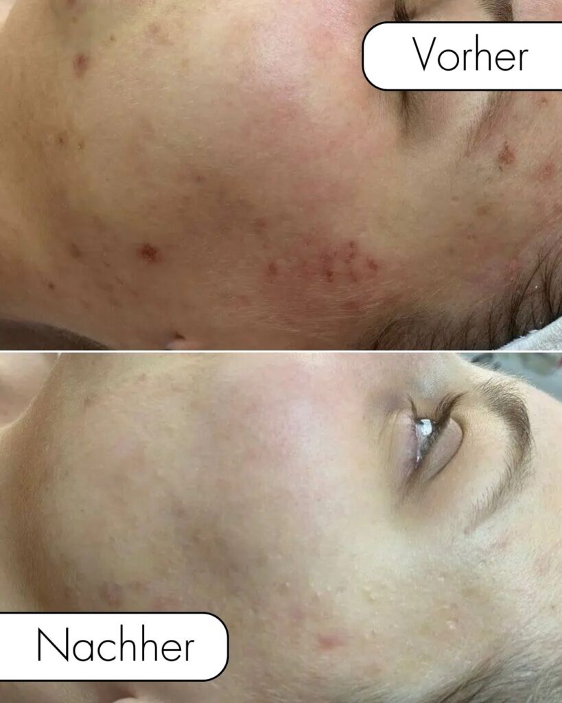 Microneedling-Behandlung_Vorher_Nachher_