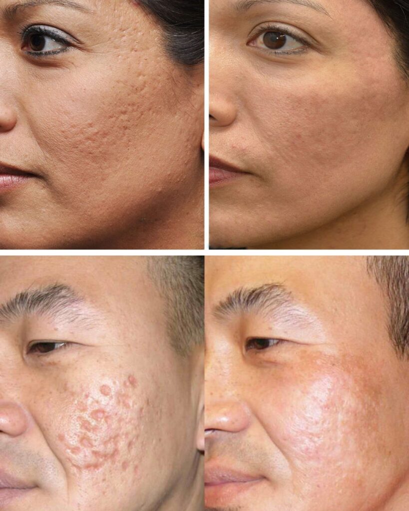 Microneedling-Behandlung_Vorher_Nachher