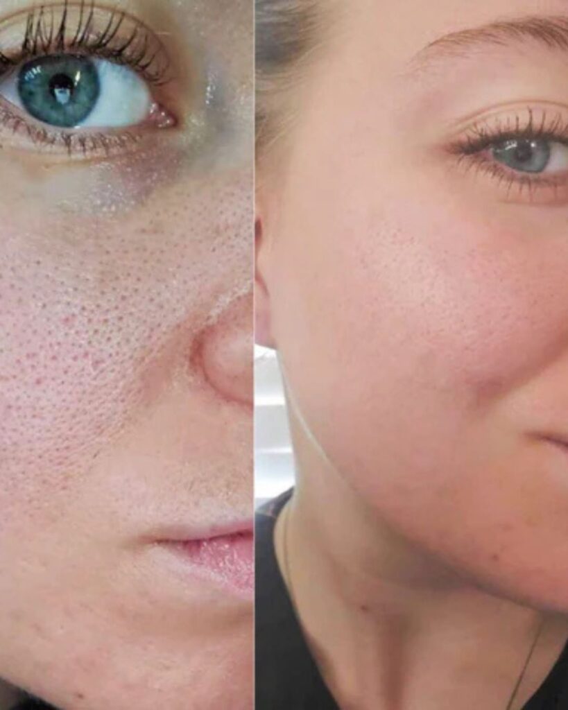 Microneedling-Behandlung_Vorher_Nachher_